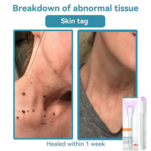 Marssirace All-in-One CO₂ Laser Eraser Pen | Removes Moles, Warts, Skin Flaws & Pigmentation