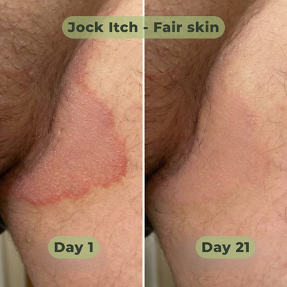 Tea Tree Antifungal Bar – Clears Fungal Infection and Skin Balance from the Root