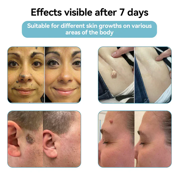Marssirace All-in-One CO₂ Laser Eraser Pen | Removes Moles, Warts, Skin Flaws & Pigmentation