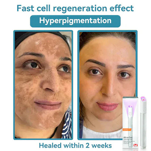 Marssirace All-in-One CO₂ Laser Eraser Pen | Removes Moles, Warts, Skin Flaws & Pigmentation