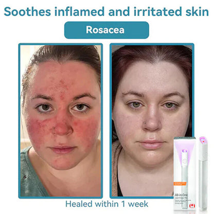 Marssirace All-in-One CO₂ Laser Eraser Pen | Removes Moles, Warts, Skin Flaws & Pigmentation