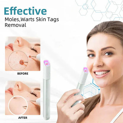Marssirace All-in-One CO₂ Laser Eraser Pen | Removes Moles, Warts, Skin Flaws & Pigmentation