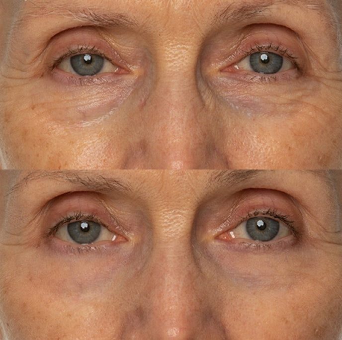 Before and after result for the appearance of fine lines