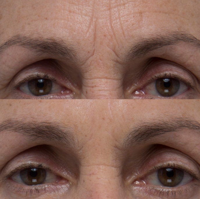 Before and after result for the appearance of 11 lines