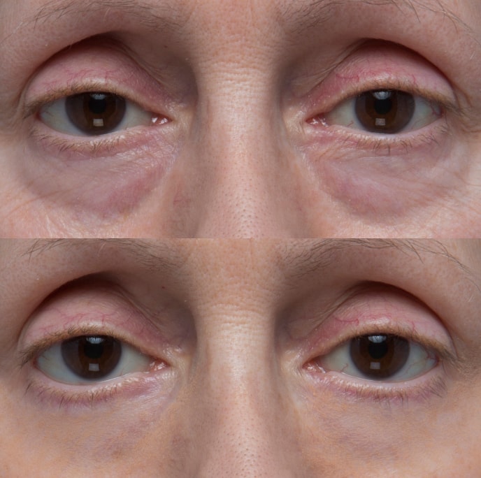 Before and after result for the appearance of dark circles