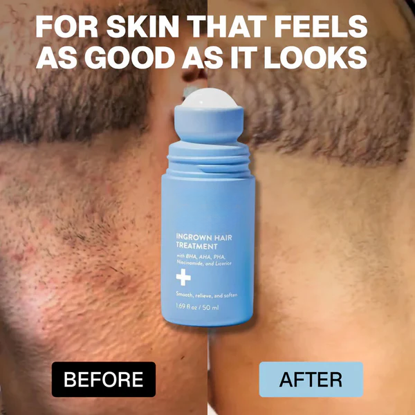 Marssirace: Smoothing Solution For Ingrown Hairs