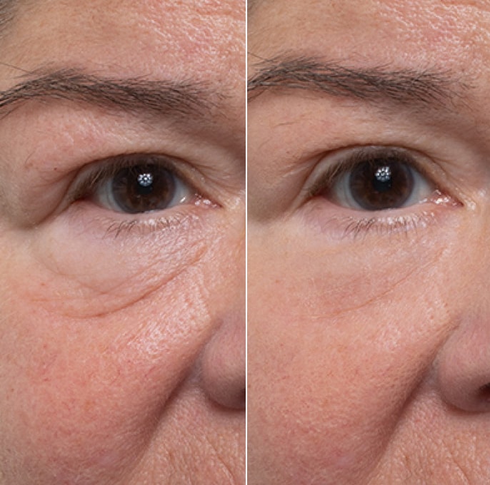 Before and after result for the appearance of under-eye bags