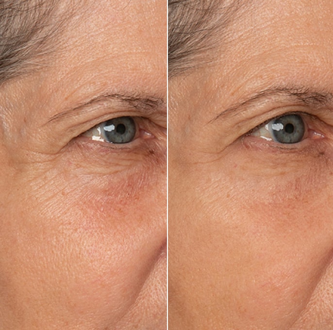 Before and after result for the appearance of fine lines and wrinkles
