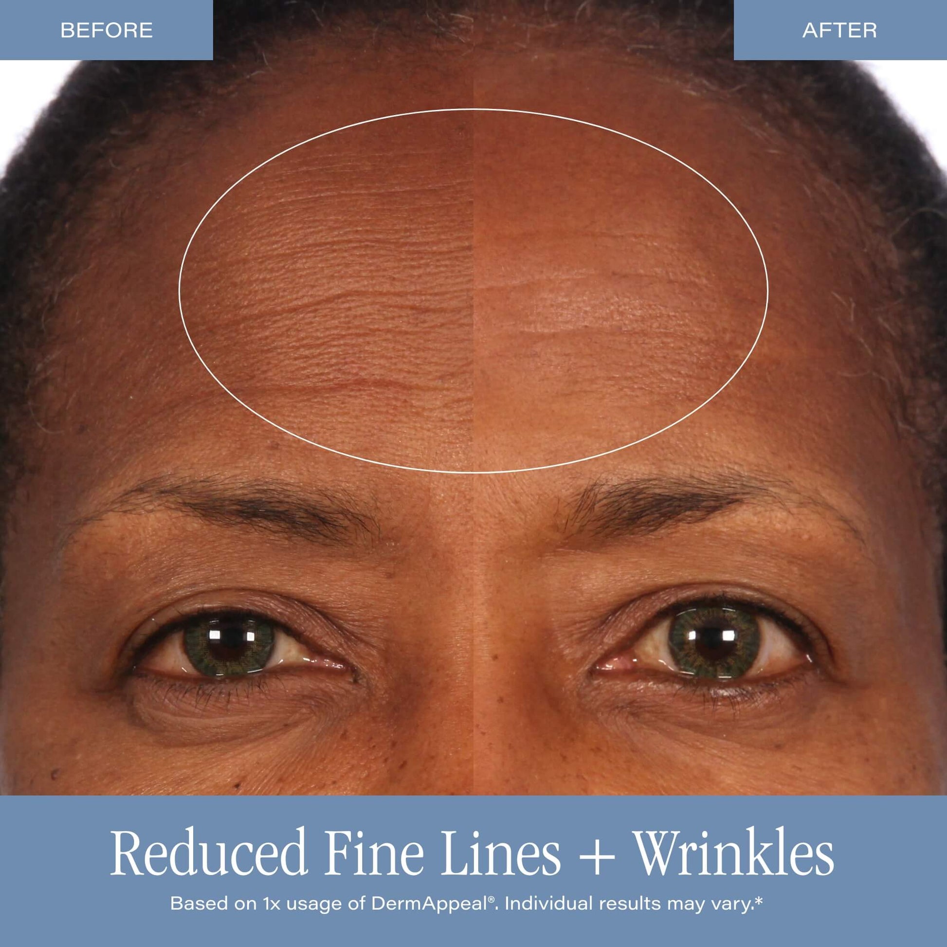Microdermabrasion Treatment w/ V5 Crystal Technology Facial Exfoliate