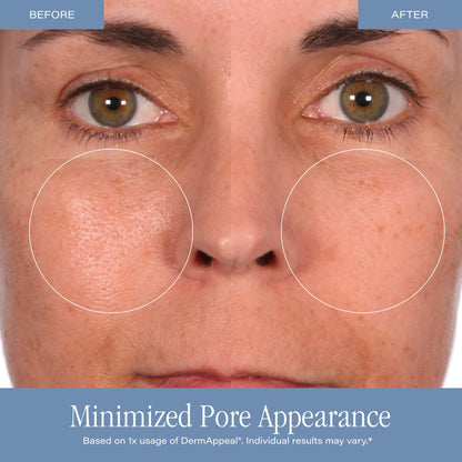 Microdermabrasion Treatment w/ V5 Crystal Technology Facial Exfoliate