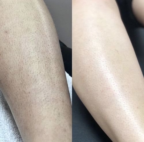 Customer body skin results