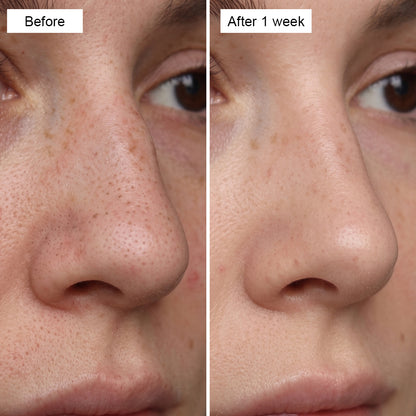 Hydrogel Nose Patches