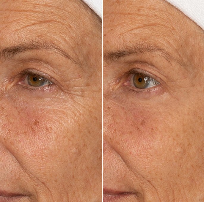Before and after result for the appearance of crow's feet