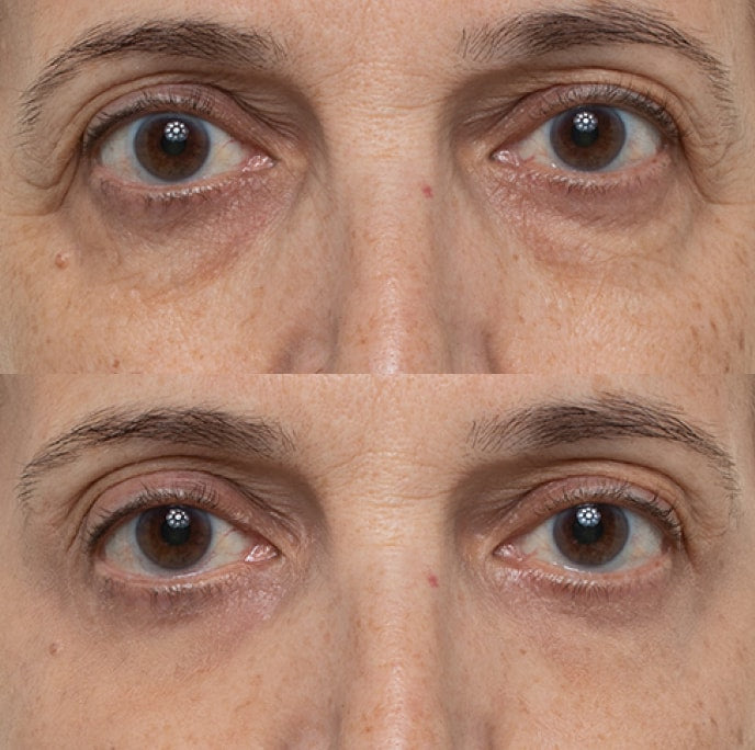 Before and after result for the appearance of dark circles