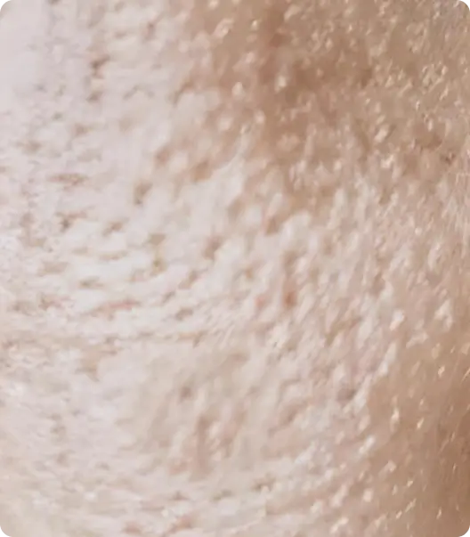 Large sagging pores