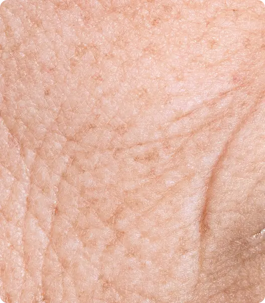 Fine lines and wrinkles