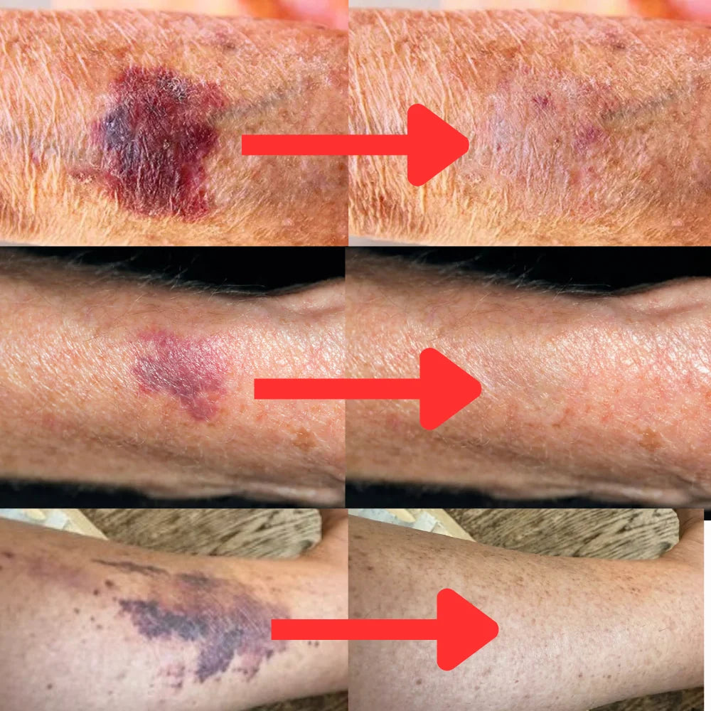 Bruise Reduction Derma Restore Serum With Arnica, Vitamin K & Ceramides